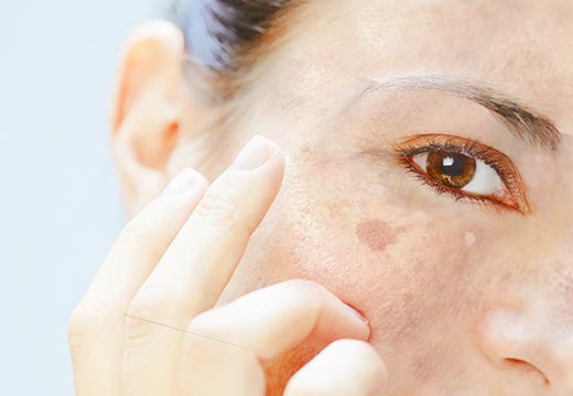 Tâches brunes sur le visage